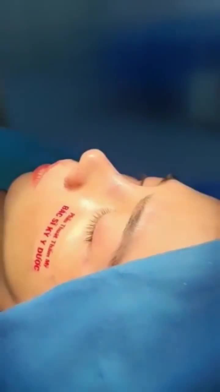 Bác sĩ Kỳ Y Dược vừa thực hiện xong ca Phẫu thuật Nâng mũi ALINE Sụn tai 2 lớp.