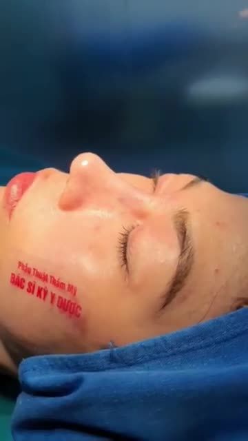 Dáng mũi hài hoà thanh tú  Kết hợp đầu mũi bo tròn túi mật, phong thuỷ Kỹ thuật an toàn - Bảo hành trọn đời