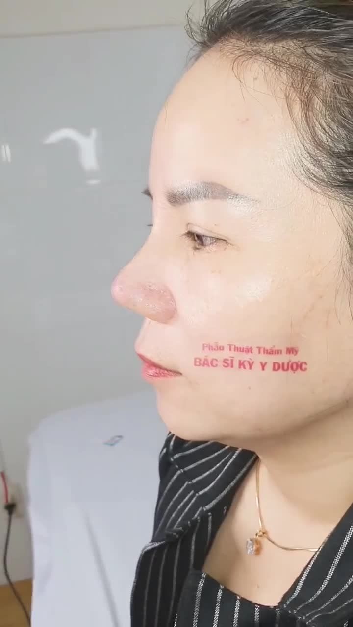 Hình ảnh ngày càng xinh đẹp chị khách sau 14 ngày Nâng Mũi Aline.
