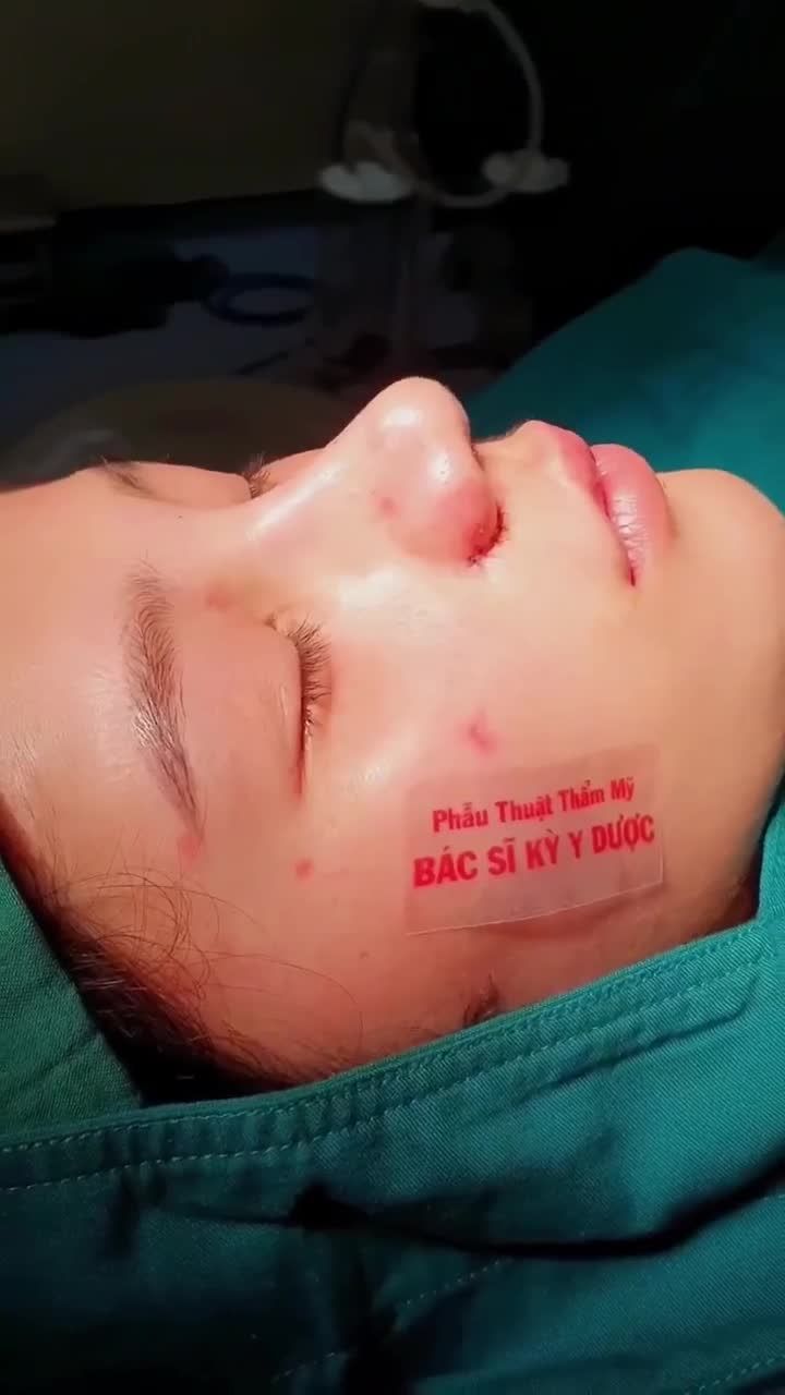 NÂNG MŨI ALINE tại cơ sở NHA TRANG