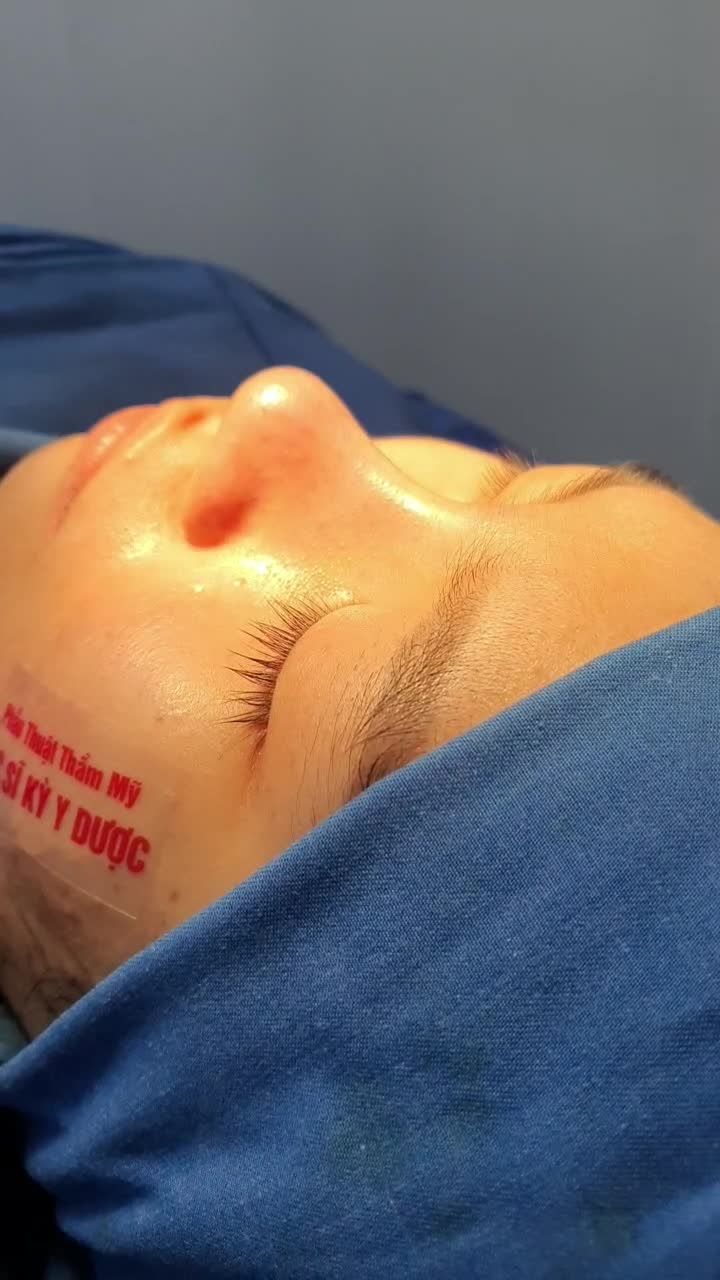 Dáng mũi được thiết kế riêng Mũi được nâng cao và kéo dài ra Đầu mũi cao nhẹ nhàng Sống mũi cong mềm mại Cánh mũi thon gọn