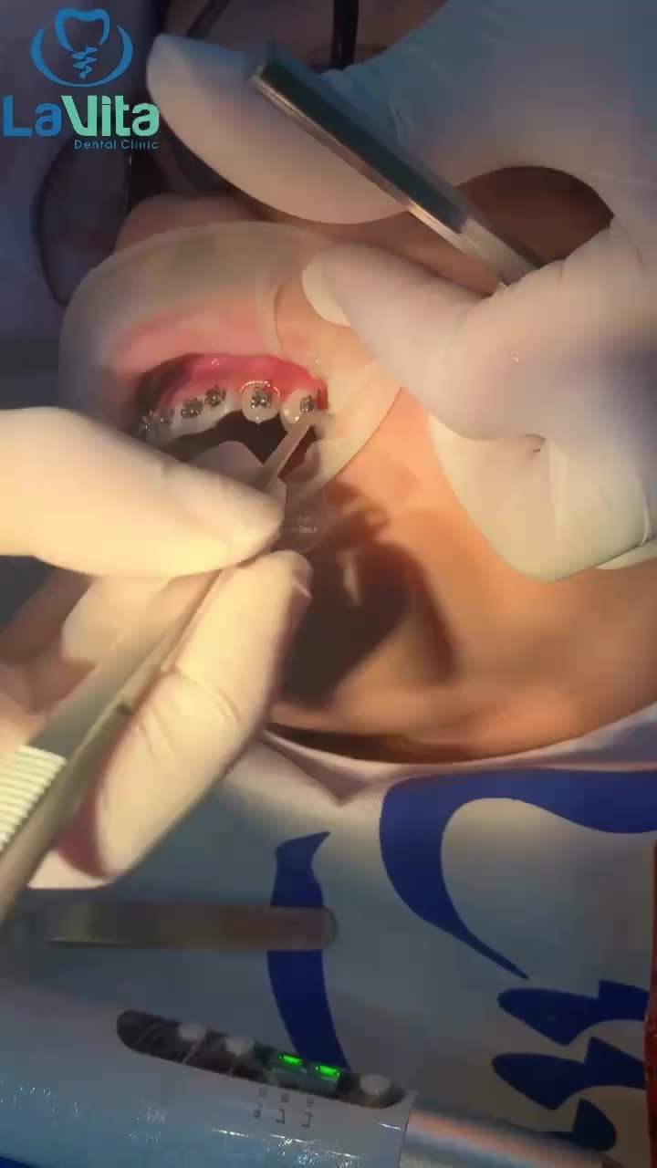 Xem thêm 13 video Niềng Răng của bác sĩ Bs nha khoa Lavita