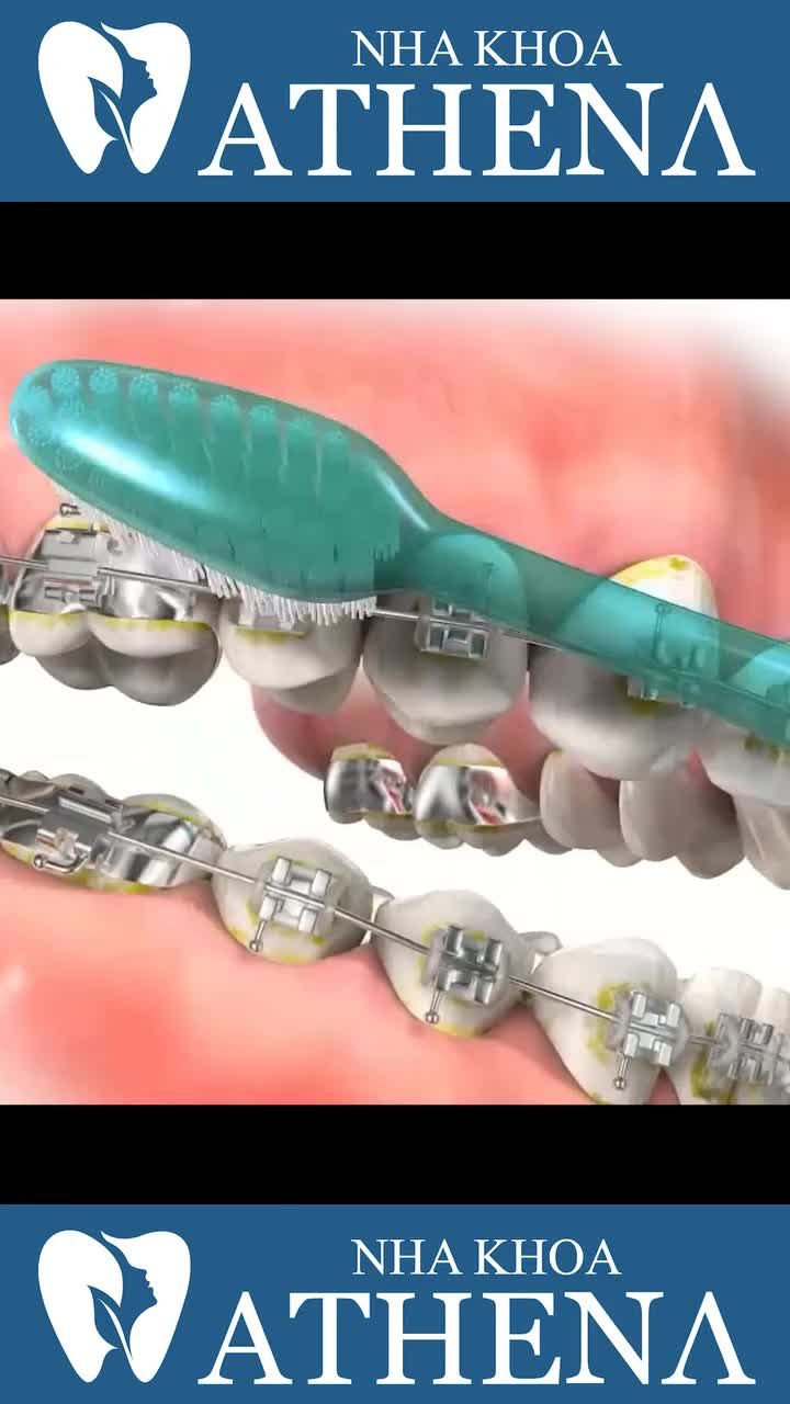 Cách vệ sinh răng miệng khi niềng răng nha khoa uy tin niềng răng