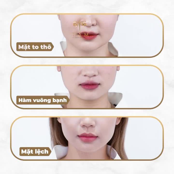 VLINE PERFECT - HÀM THON GỌN CHỈ SAU 1 LIỆU TRÌNH 45 PHÚT