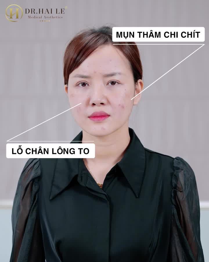 Tổ hợp trị liệu tái tạo, tái sinh làn da đa lớp Medi-RBA tại Dr.Hải Lê đã và đang là xu hướng làm đẹp được ưa chuộng trong năm 2024.