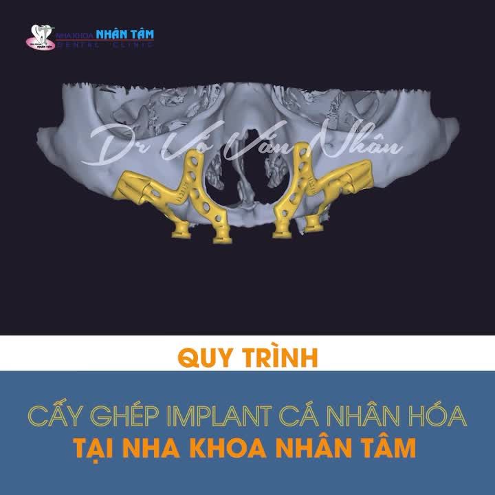 Quy trình cấy ghép Implant cá nhân hóa tại Nha khoa Nhân Tâm