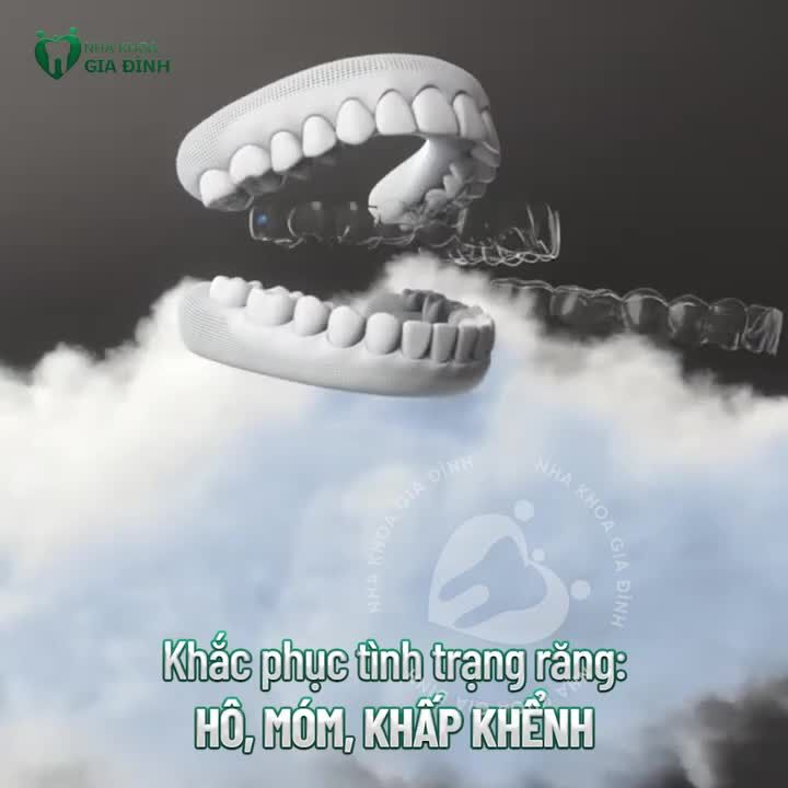 NIỀNG KHÔNG AI BIẾT - ĐẸP AI CŨNG HAY VỚI NIỀNG RĂNG INVISALIGN
