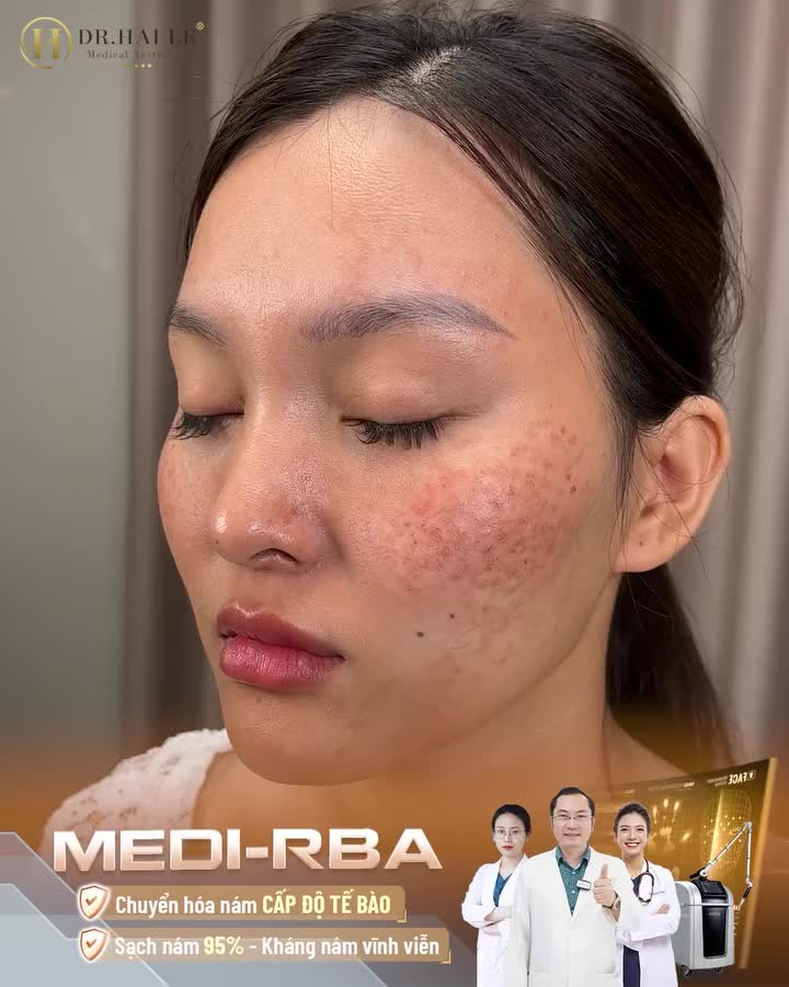 Nám dày đặc hơn sau sinh khi trị nám không đúng cách có thể khiến cho chị Nguyệt Anh - 30 tuổi có thể sống chung với nám cả đời. Nền da của chị Nguyệt Anh mỏng yếu và đen sạm.