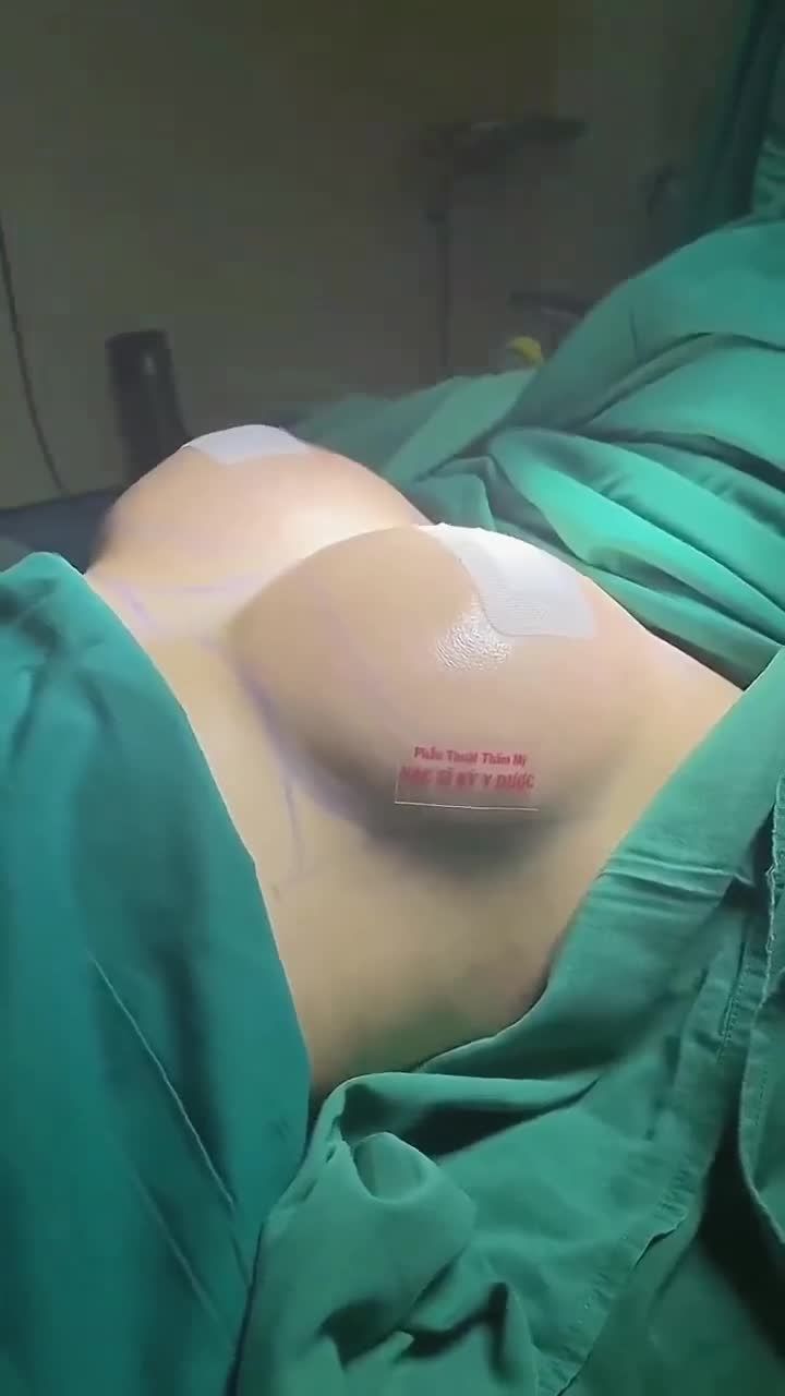 Nâng Ngực Nội Soi Chân Không Đường Nách