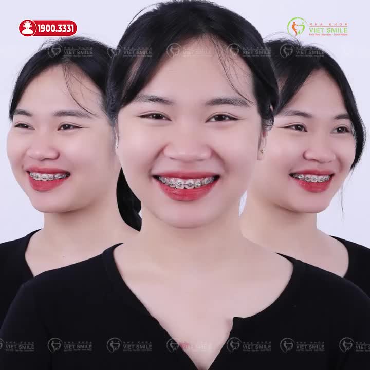 GEN Z NIỀNG RĂNG CÓ GÌ ĐẶC BIỆT?