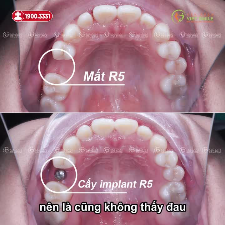 KHÁCH HÀNG NÓI GÌ KHI TRỒNG IMPLANT TẠI VIET SMILE