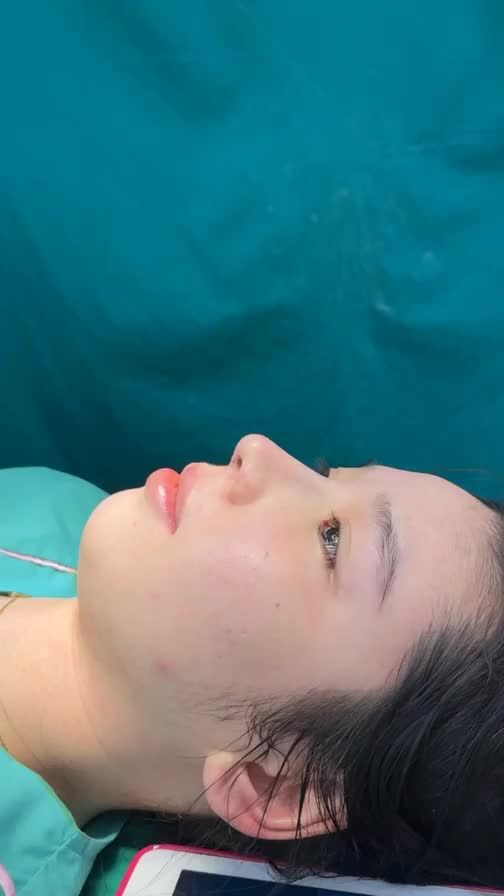 Case mũi cấu trúc hoàn thành sau 90 phút!!