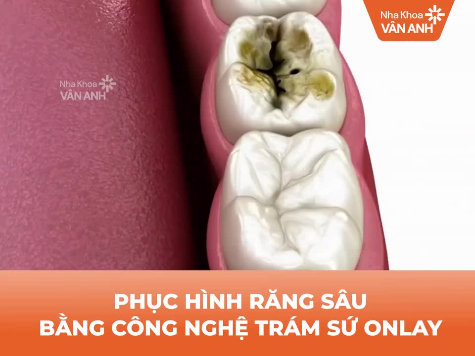 INLAY/ONLAY - GIẢI PHÁP PHỤC HÌNH RĂNG SÂU VỠ LỚN