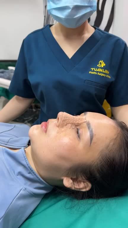 Cận cảnh dáng mũi bọc sụn sau 10 ngày!!