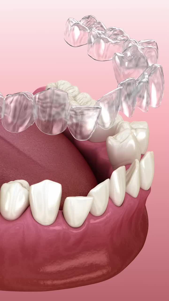 Top những loại mắc cài niềng răng mà bạn cần biết