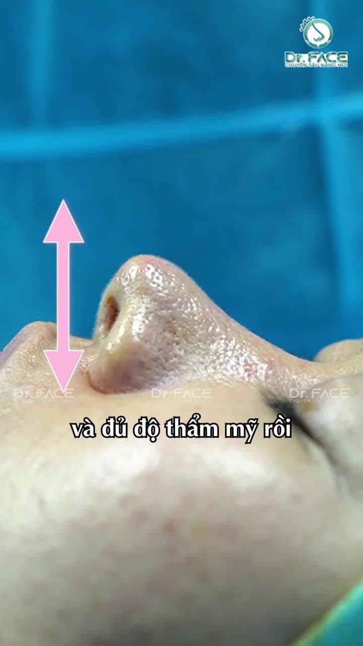 Mũi này CHỌN CẤU TRÚC là SAI LẦM