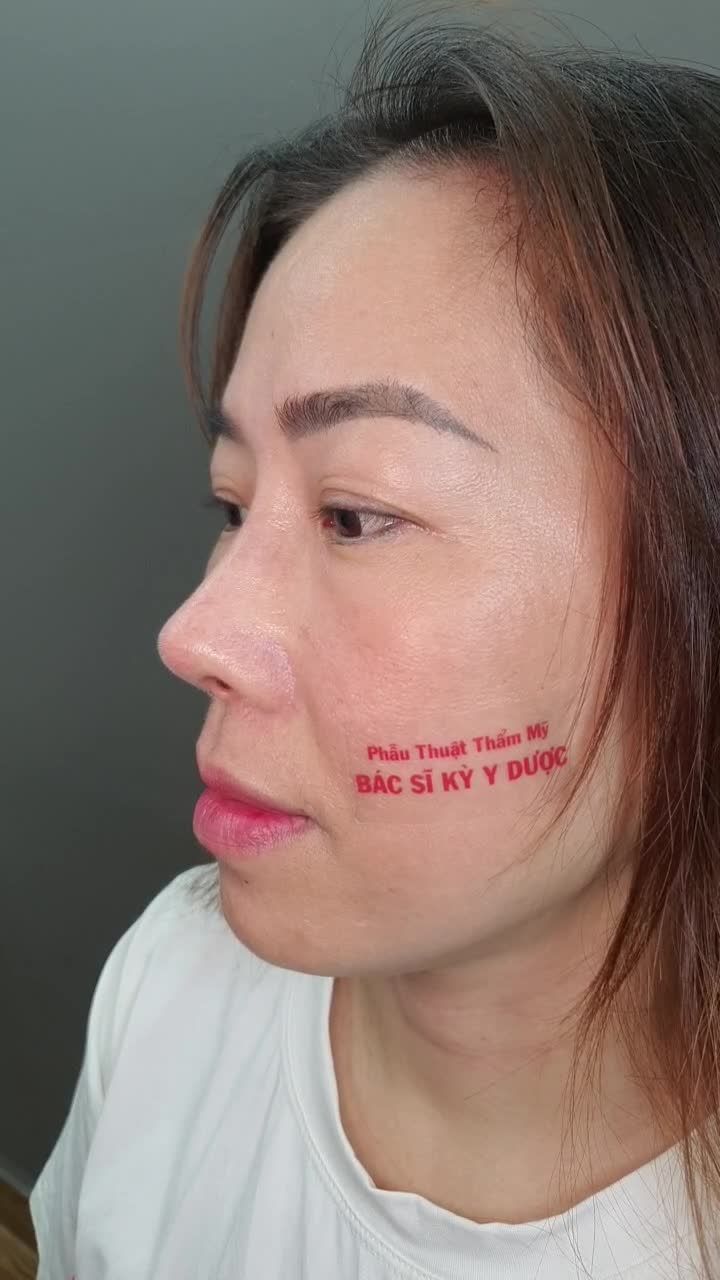 KẾT QUẢ NGỌT NGÀO SAU NÂNG MŨI ALINE