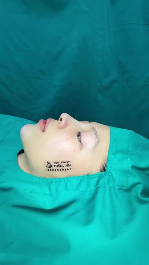 Nâng mũi siêu cấu trúc TẶNG ngay độn cằm - Khuyến mãi đến hết 2.5.2024=> Khách hàng tranh thủ đặt lịch trong hôm nay để giữ ƯU ĐÃI nha!