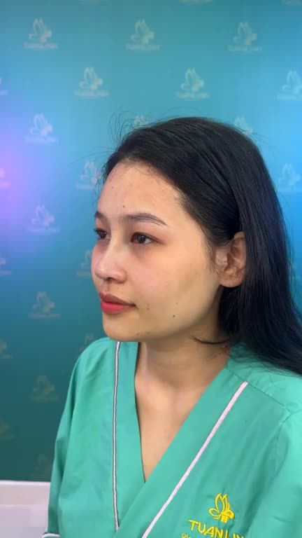 Gặp gỡ bạn khách hàng đến từ Đồng Tháp sau 90 phút thực hiện nâng mũi cấu trúc!
