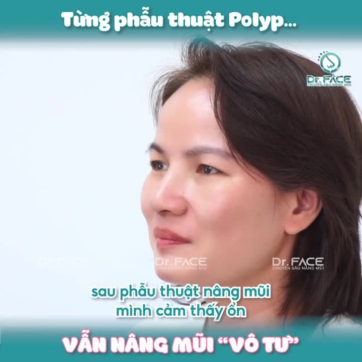 Từng Phẫu Thuật Polyp…Vẫn Nâng Mũi “Vô Tư”