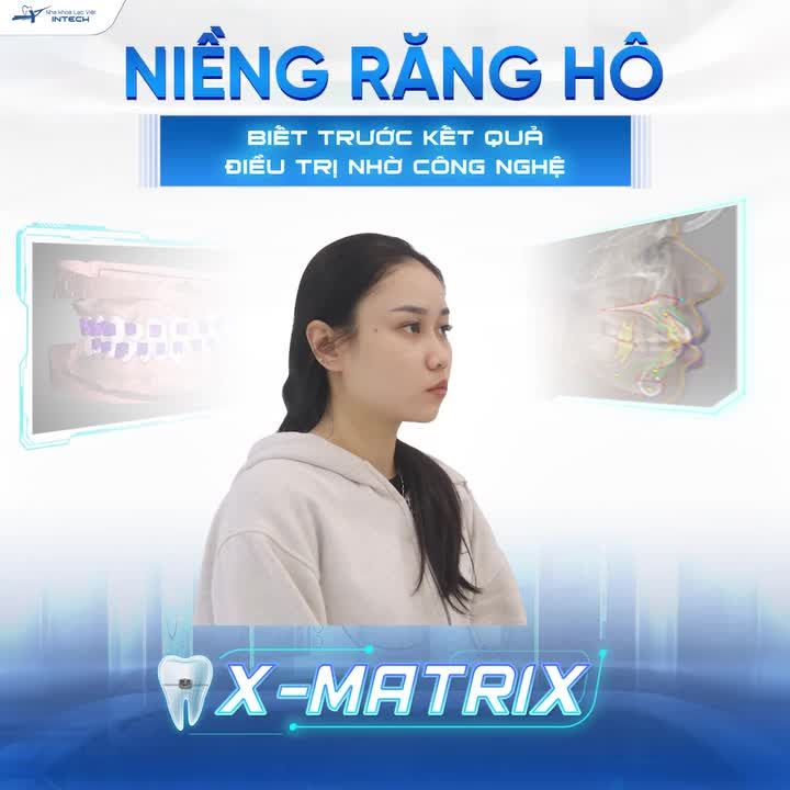 MÔ PHỎNG KẾT QUẢ ĐIỀU TRỊ RĂNG HÔ KHÔNG CẦN NHỔ RĂNG VỚI CÔNG NGHỆ X-MATRIX