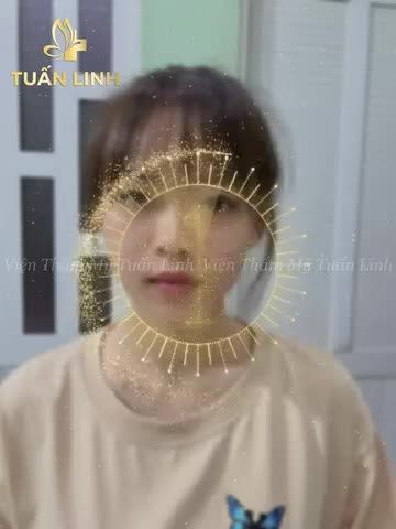 REVIEW HÀNH TRÌNH :  1 tháng thay đổi bất ngờ sau nâng mũi