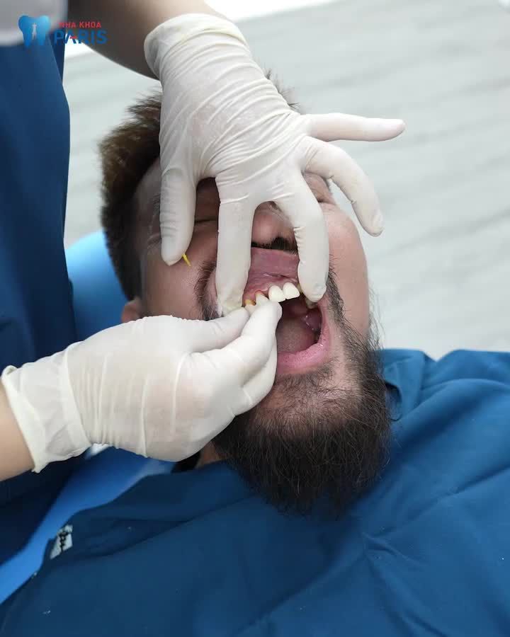 Sau khi tới nha khoa Paris và được đội ngũ bác sĩ thăm khám, tư vấn, anh quyết định tháo răng cũ và làm lại răng mới với một chiếc răng khểnh duyên dáng. Hãy cùng xem kết quả của anh Long nhé!