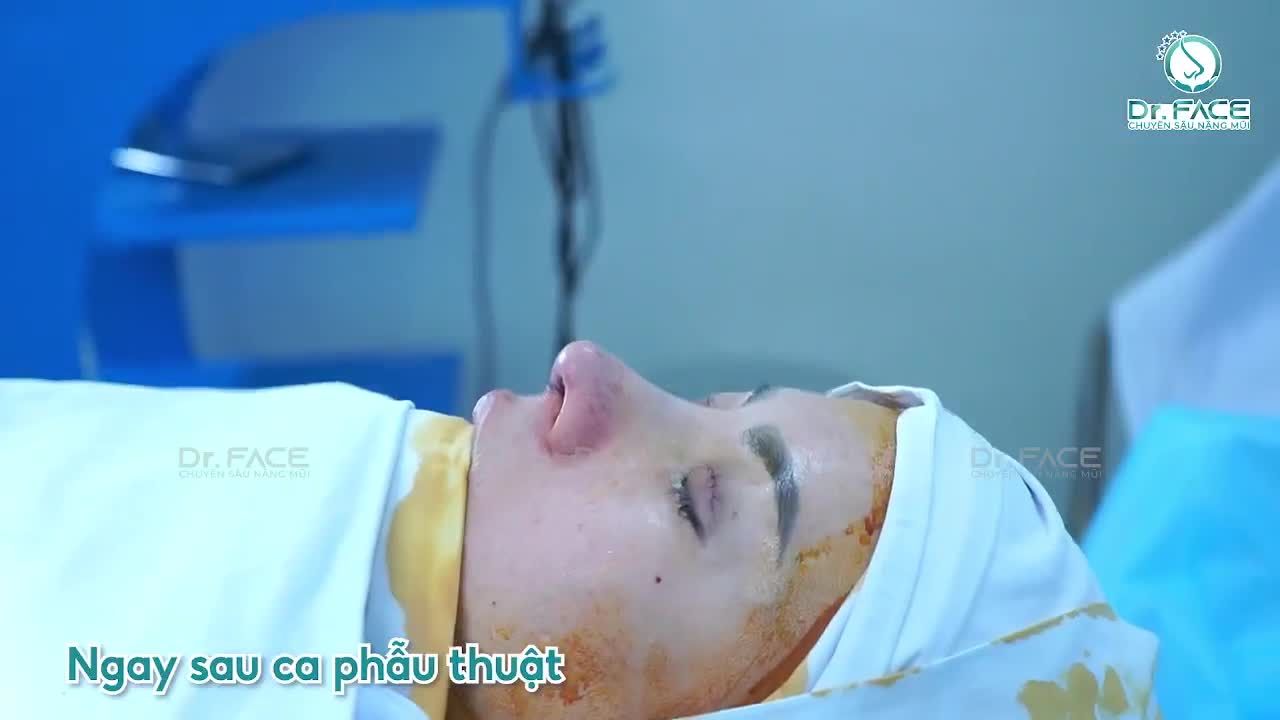 Combo đẹp toàn diện: Nâng Mũi Sụn Sườn + Cắ.t Mí Trên + Cấy Mỡ Mí Dưới, Cằm