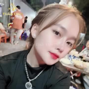 "Lột x.ác" ngoạn mục sau nâng mũi cấu trúc Surgiform tại Tuấn Linh!!
