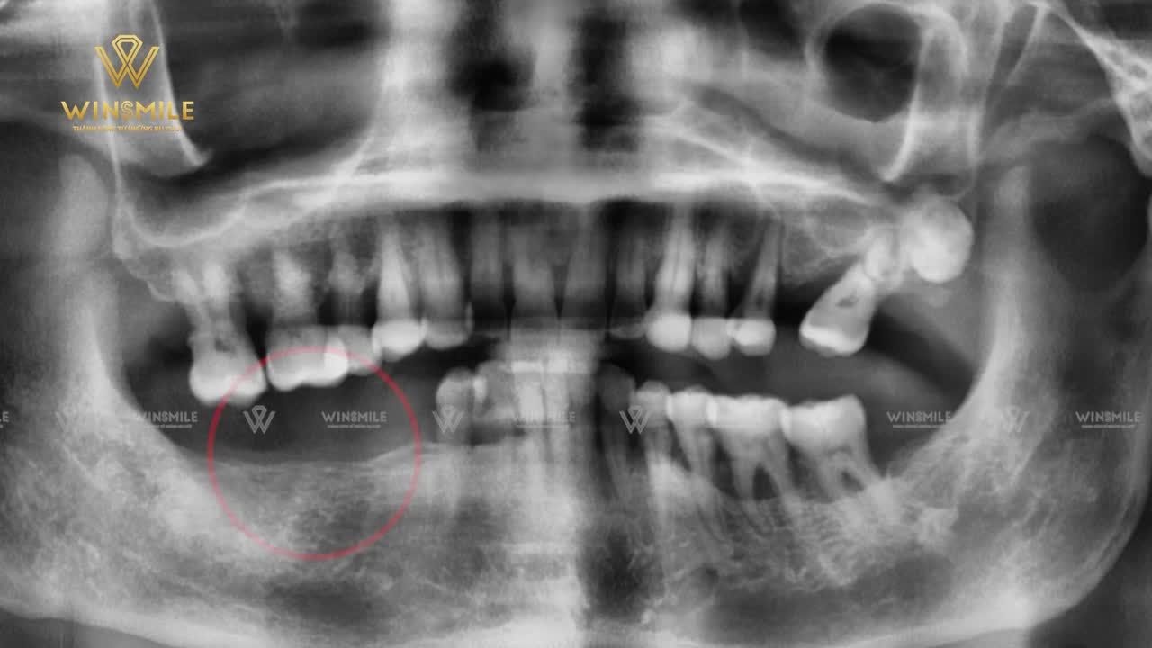 KIỀU BÀO MỸ CHIA SẺ CẢM NHẬN SAU KHI TÌM LẠI NỤ CƯỜI TRỌN VẸN THẨM MỸ - ĂN NHAI