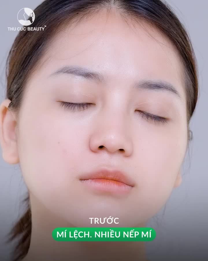 15P chia tay tình trạng mí lệch, nhiều nếp mí >> Chọn Mắt TC