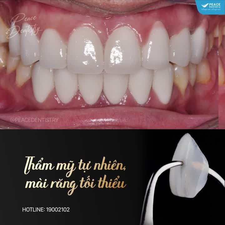 Xem thêm 5 video Mặt Dán Sứ Veneer của bác sĩ Bs nha khoa Peace Dentistry