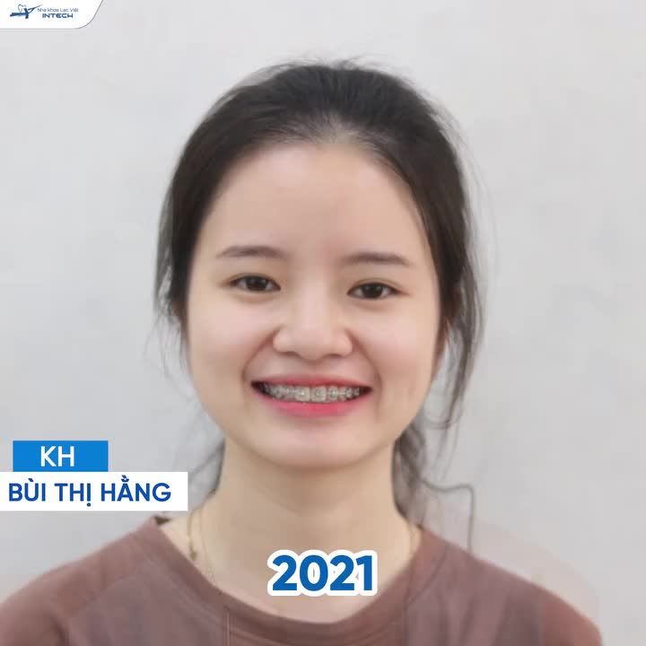 NHỮNG MÀN “LỘT XÁC ĐỈNH CAO” SAU KHI NIỀNG RĂNG KHẤP KHỂNH!