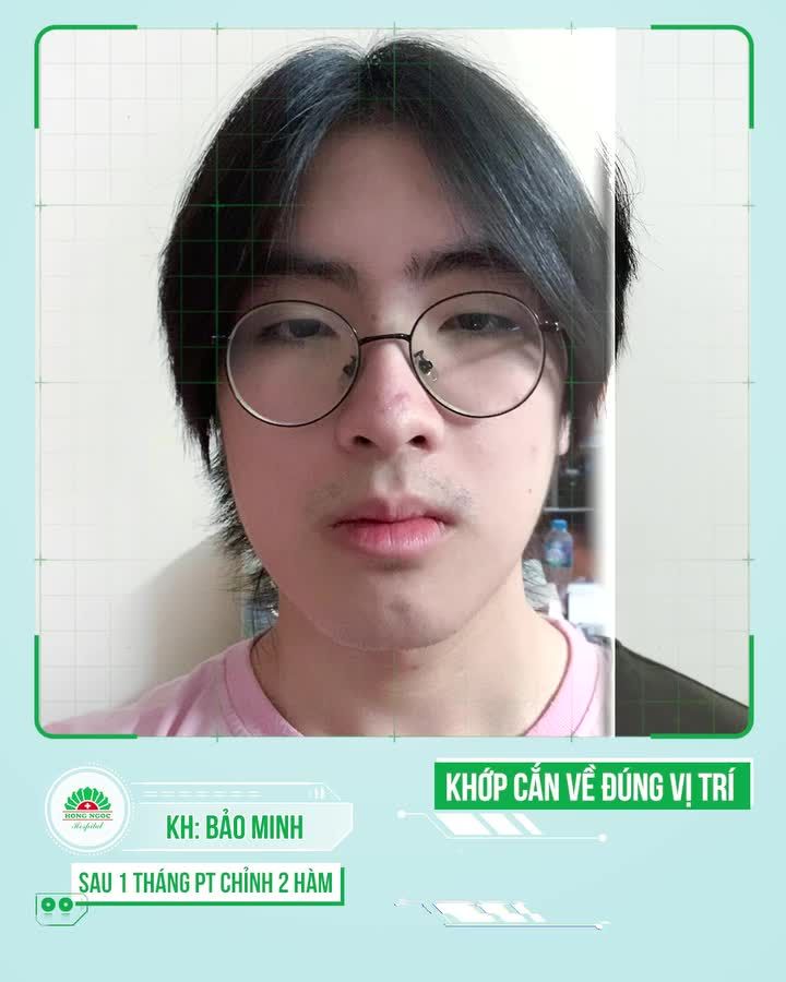 LỆCH KHỚP CẮN KIỂU HÌNH HẠNG 3 SAU 1 THÁNG THAY ĐỔI NHƯ THẾ NÀO