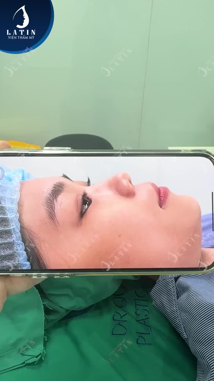 Kết quả nâng mũi cấu trúc cho em gái đến từ Đồng Nai
