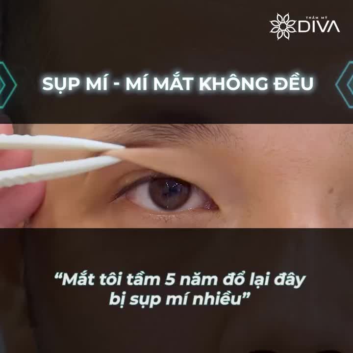 SỤP MÍ - MÍ MẮT KHÔNG ĐỀU PHƯƠNG PHÁP NÀO CẢI THIỆN?