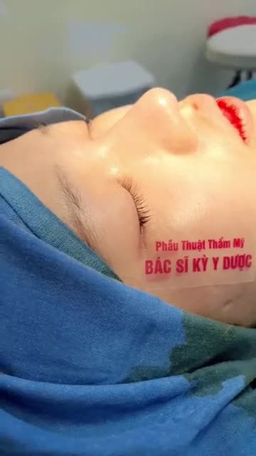 Hoàn thành ca nâng mũi ALINE Bán cấu trúc 2 lớp cho khách hàng đón hè về.
