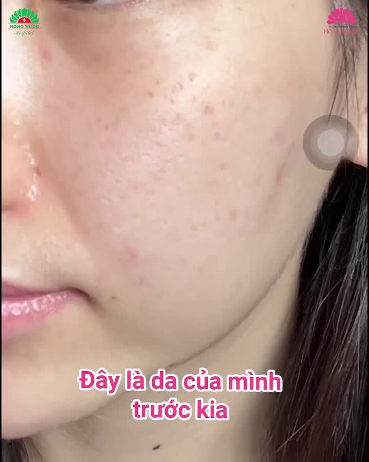 Team da khô, da bong tróc, nhiều khuyết điểm đừng bỏ qua Video này
