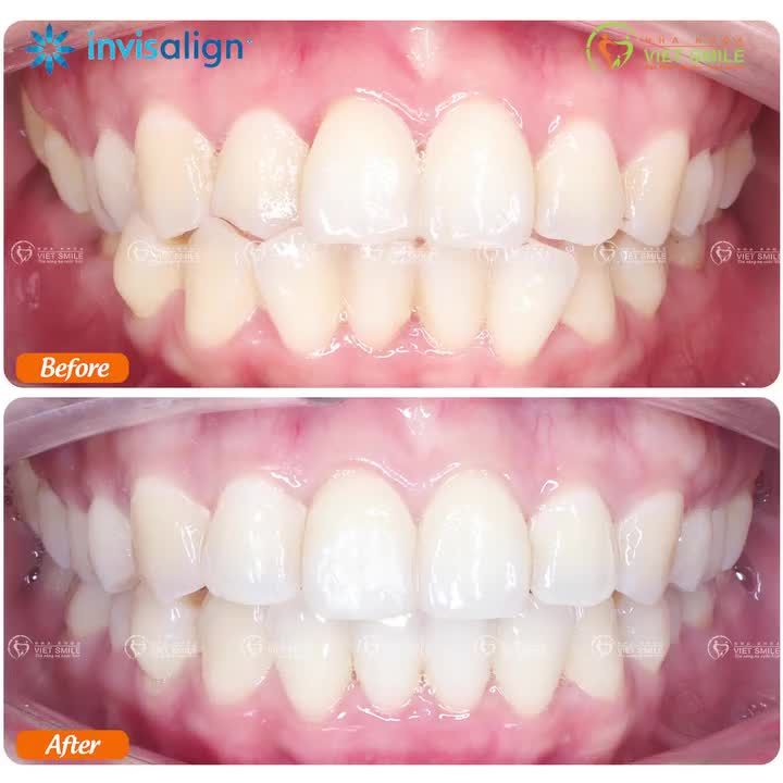 BẤT NGỜ SAU 1 NĂM NIỀNG RĂNG INVISALIGN