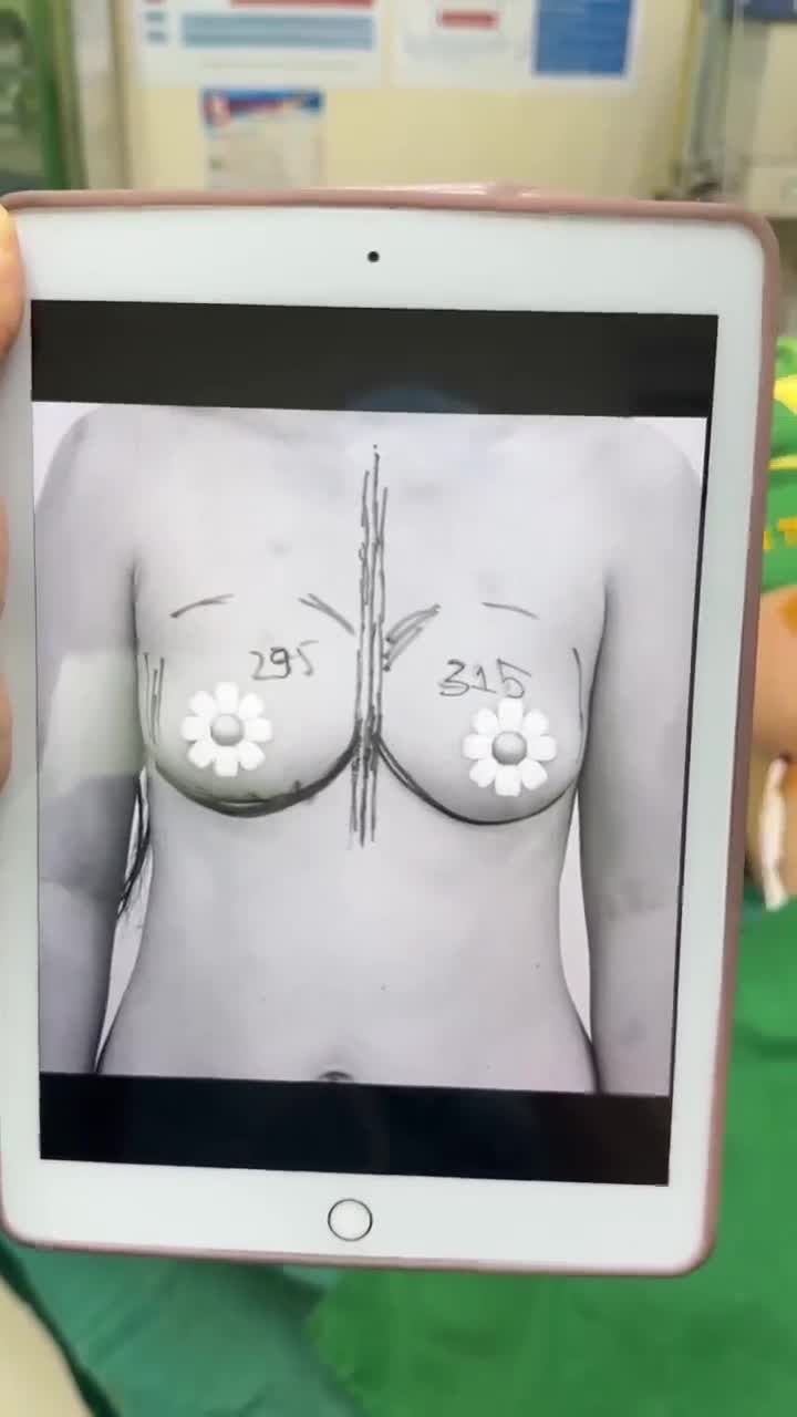 NÂNG NGỰC KHÔNG CHẠM