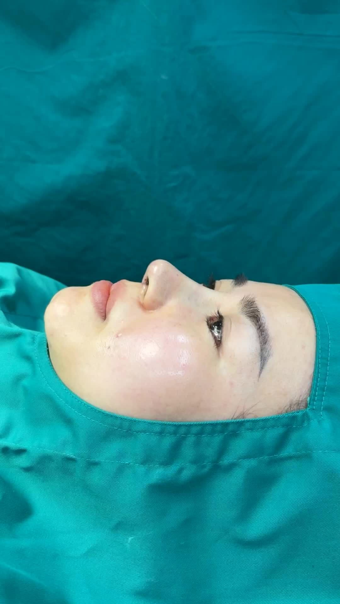 Case mũi cấu trúc vừa hoàn thành cho bạn gái đến từ Kiên Gian