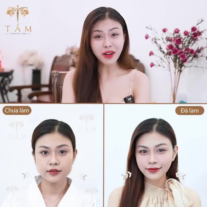 VLINE PERFECT HÀMTHONGỌN CHỈ SAU 1 LIỆU TRÌNH 45 PHÚT