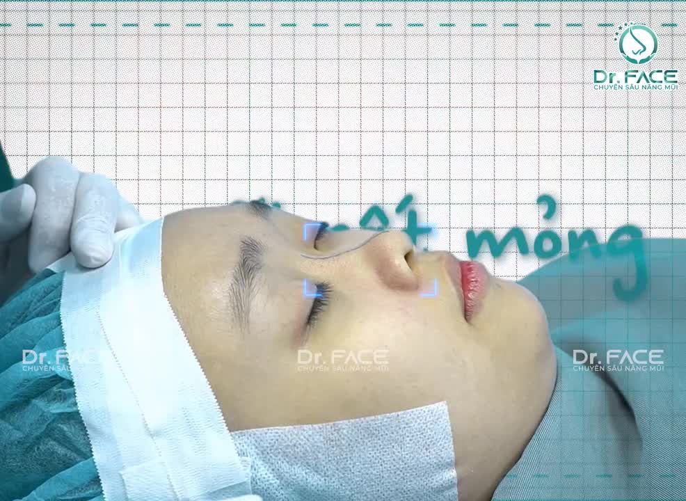 “KHÔNG CÓ SỐNG MŨI” vào nghe bác sĩ phân tích về NÂNG MŨI liền