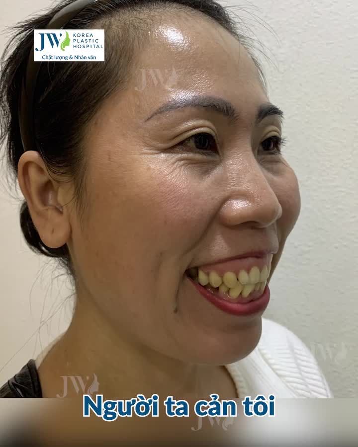 QUÝ CÔ U50 CẮT 2 HÀM XINH ĐẸP - GIA ĐÌNH KHEN NHƯ DIỄN VIÊN