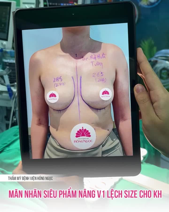 MÃN NHÃN KẾT QUẢ NÂNG V1 LỆCH SIZE CHO KH THỰC HIỆN BỞI BS TÙNG