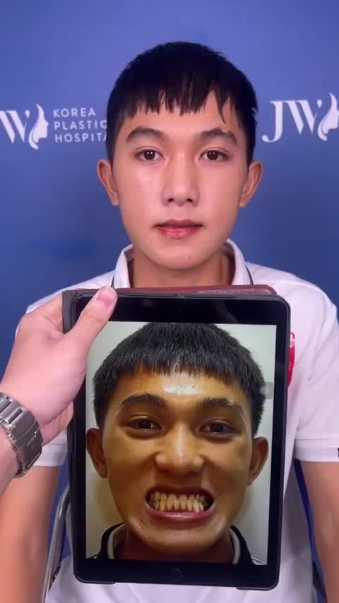 CHIÊM NGƯỠNG vẻ đẹp như HOT BOY của chàng trai GEN Z sau PHẪU THUẬT HÀM GIẢM ngay 15 Triệu Phẫu thuật Hàm tại đây: https://benhvienjw.com/uudaifb