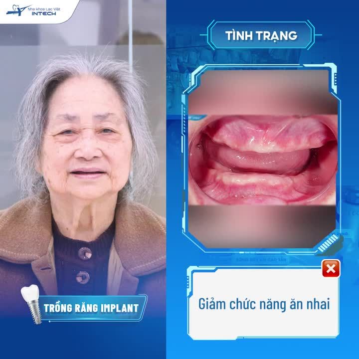 U80 THAY ĐỔI NGOẠN MỤC SAU TRỒNG RĂNG IMPLANT