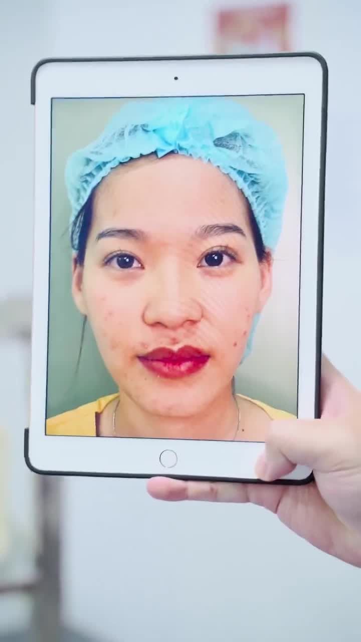 Combo Nâng mũi + Độn vùng trên gò má Dr.Hải Lê Sài Gòn - Gương mặt đầy đặn, dáng mũi tự tin!