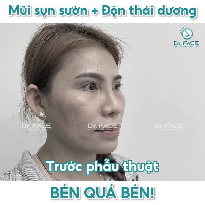 Combo MŨI SỤN SƯỜN + ĐỘN THÁI DƯƠNG bén quá bén!