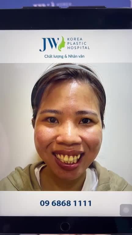 CHẤN ĐỘNG với KẾT QUẢ phẫu thuật HÀM HÔ khiến Chị gái U30 giúp NHAN SẮC thay đổi xuất sắc Tiết kiệm 20 Triệu, Phẫu thuật hàm đăng ký tại đây: https://benhvienjw.com/trogiafb
